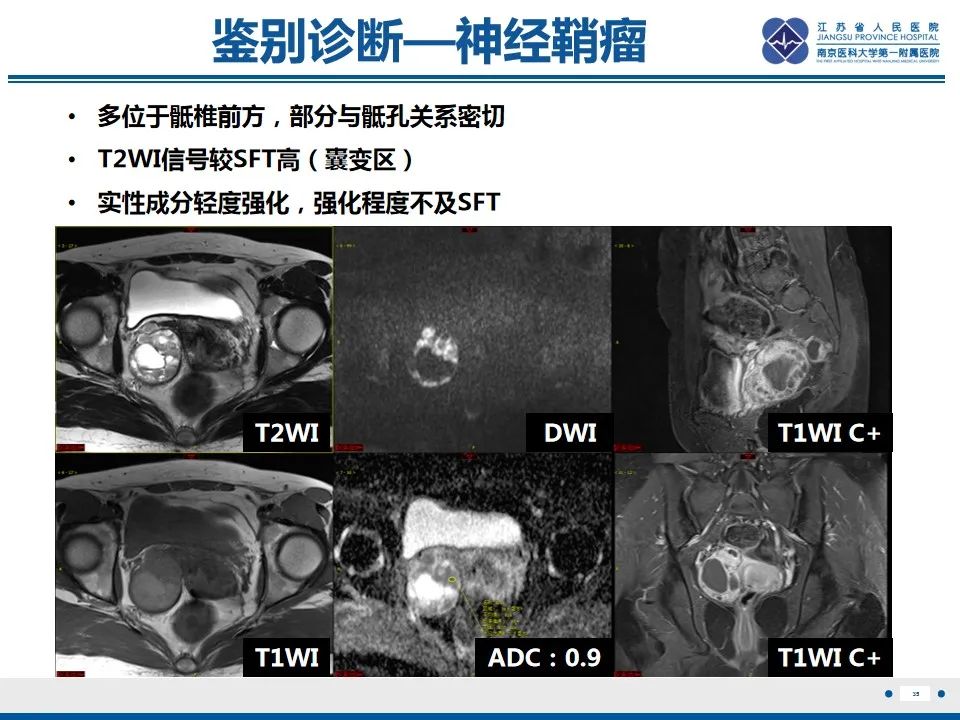 影像PPT - 【PPT】盆腔孤立性纤维瘤-36
