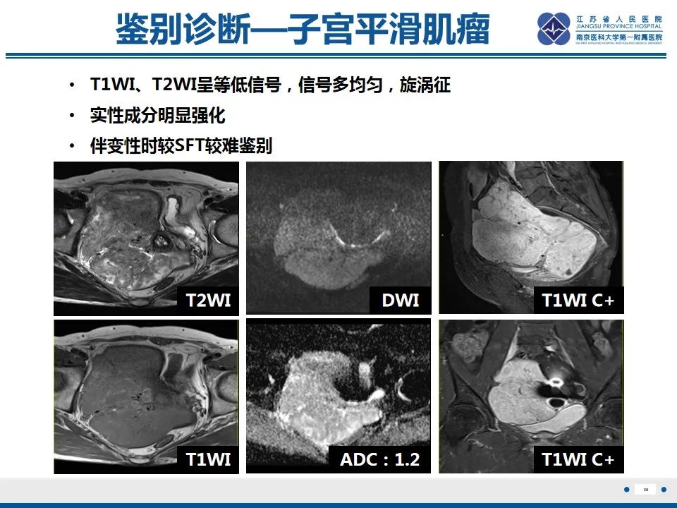 影像PPT - 【PPT】盆腔孤立性纤维瘤-37