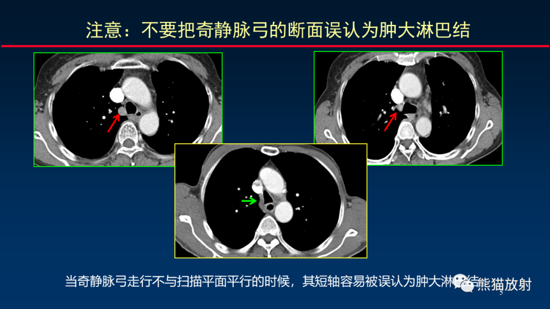 影像PPT - 【PPT】纵隔与肺门淋巴结的识别与精准CT分区-5