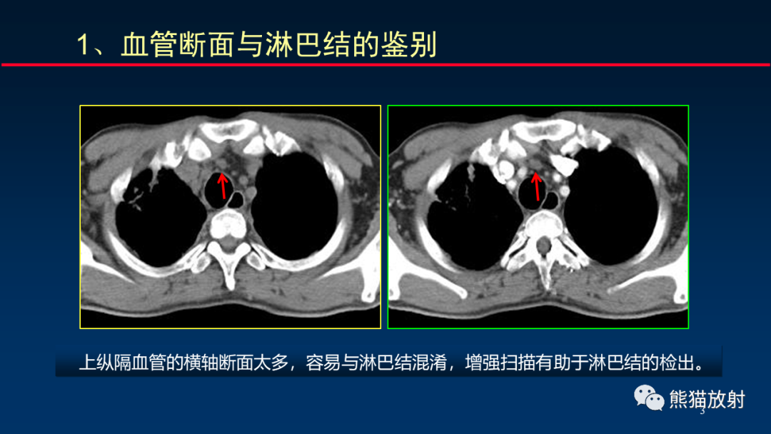 影像PPT - 【PPT】纵隔与肺门淋巴结的识别与精准CT分区-3