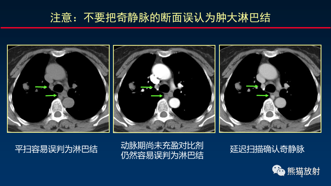 影像PPT - 【PPT】纵隔与肺门淋巴结的识别与精准CT分区-4
