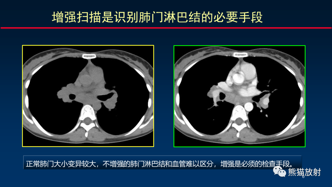 影像PPT - 【PPT】纵隔与肺门淋巴结的识别与精准CT分区-6