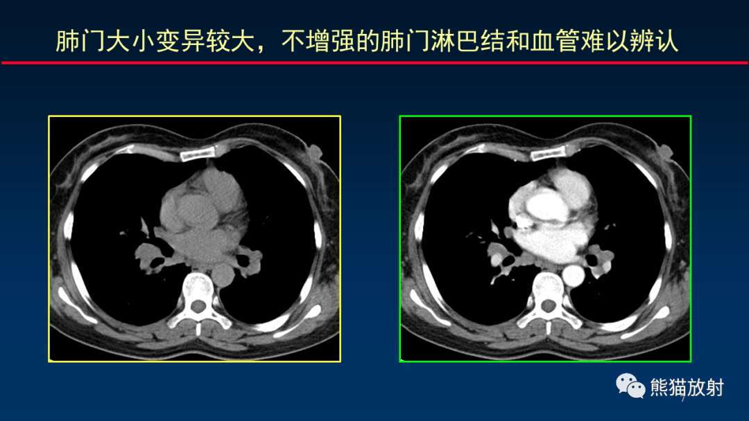 影像PPT - 【PPT】纵隔与肺门淋巴结的识别与精准CT分区-7