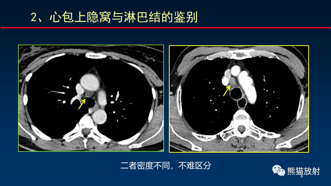 影像PPT - 【PPT】纵隔与肺门淋巴结的识别与精准CT分区-8