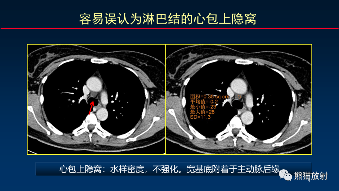 影像PPT - 【PPT】纵隔与肺门淋巴结的识别与精准CT分区-9