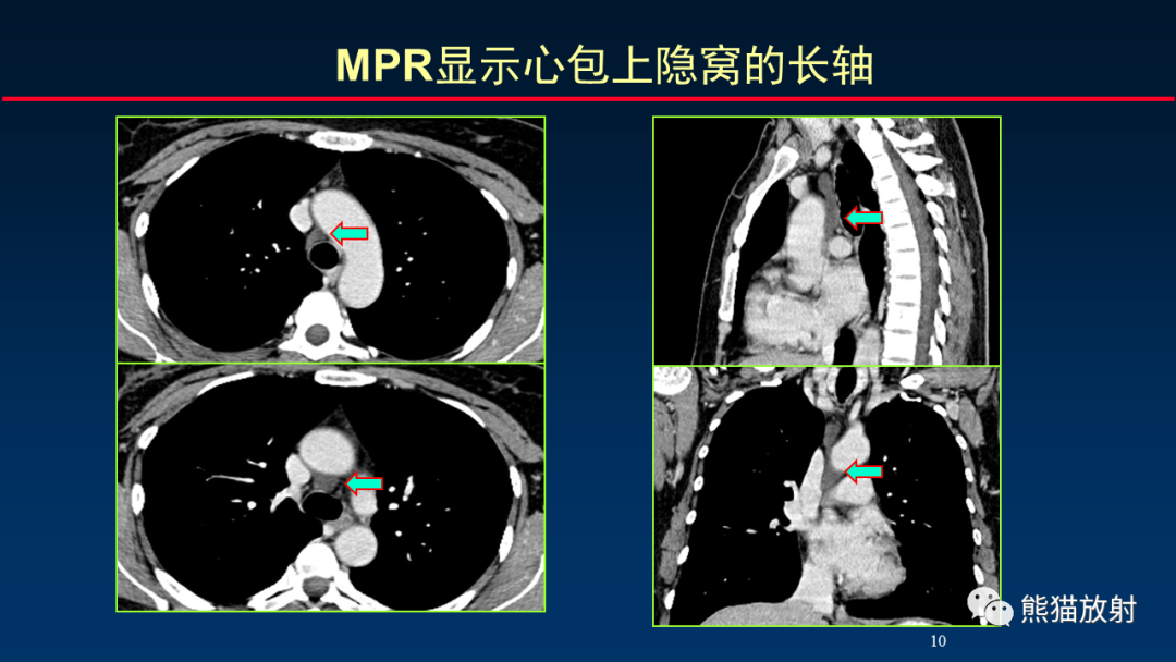 影像PPT - 【PPT】纵隔与肺门淋巴结的识别与精准CT分区-10