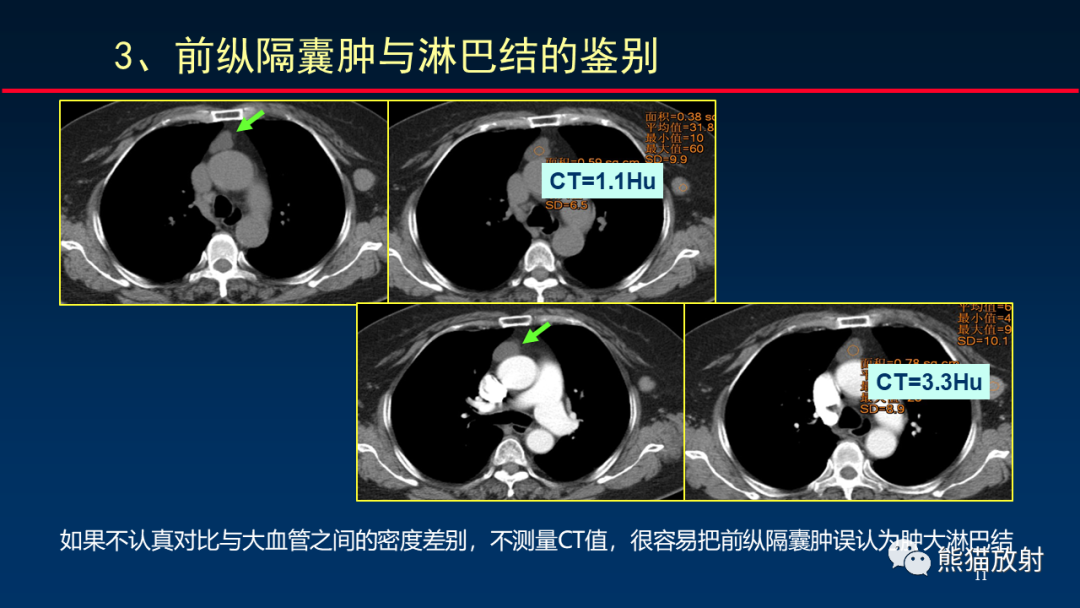影像PPT - 【PPT】纵隔与肺门淋巴结的识别与精准CT分区-11