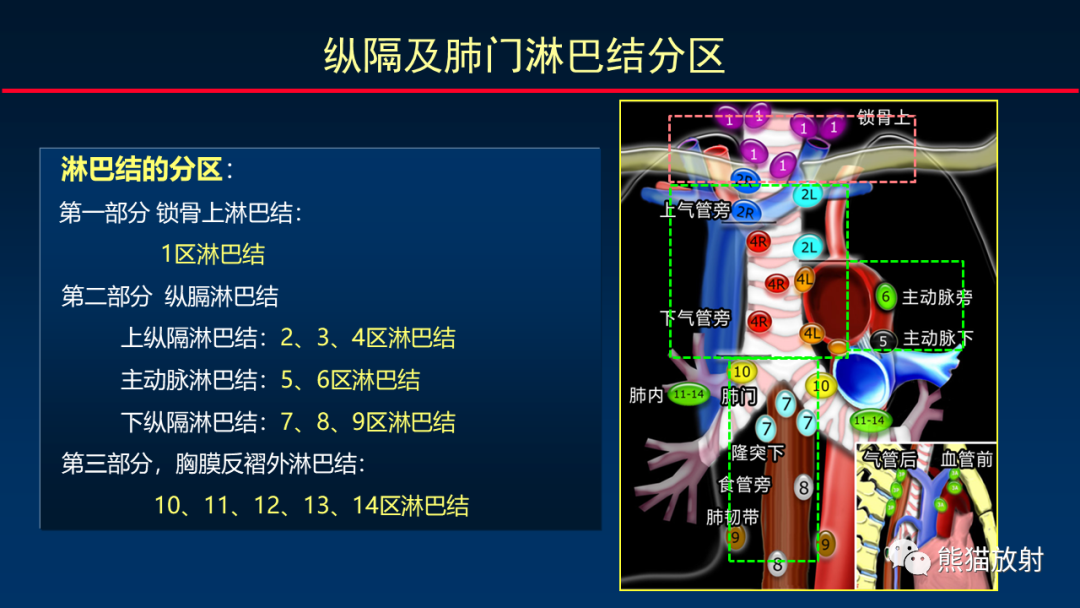 影像PPT - 【PPT】纵隔与肺门淋巴结的识别与精准CT分区-13