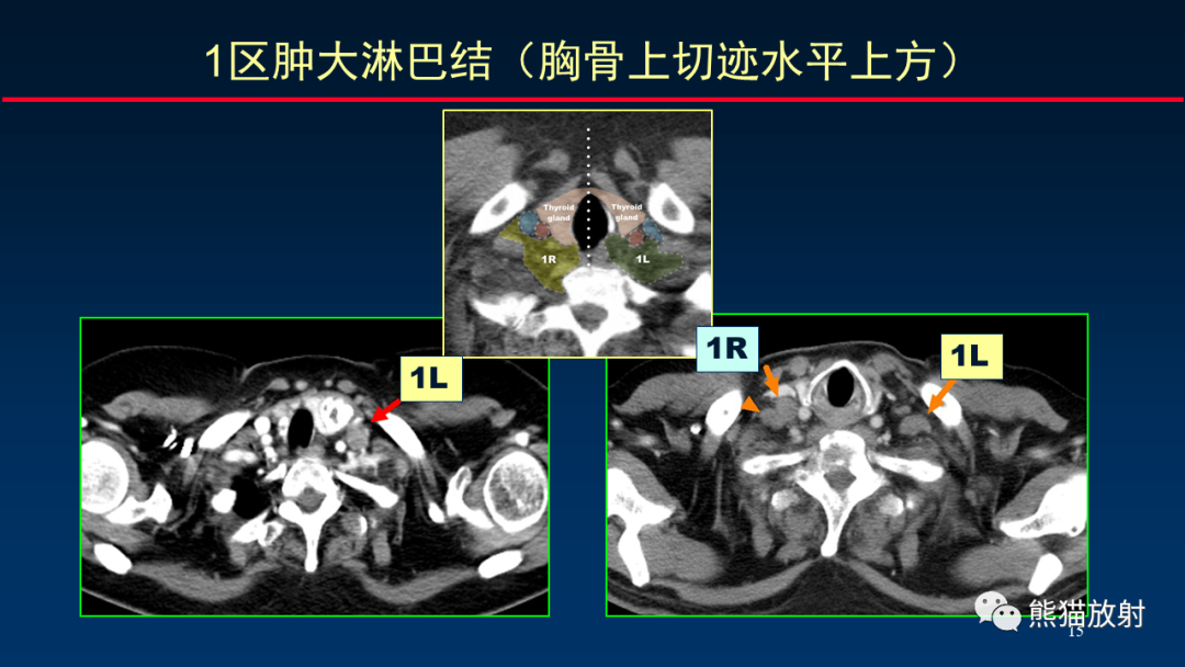 影像PPT - 【PPT】纵隔与肺门淋巴结的识别与精准CT分区-15