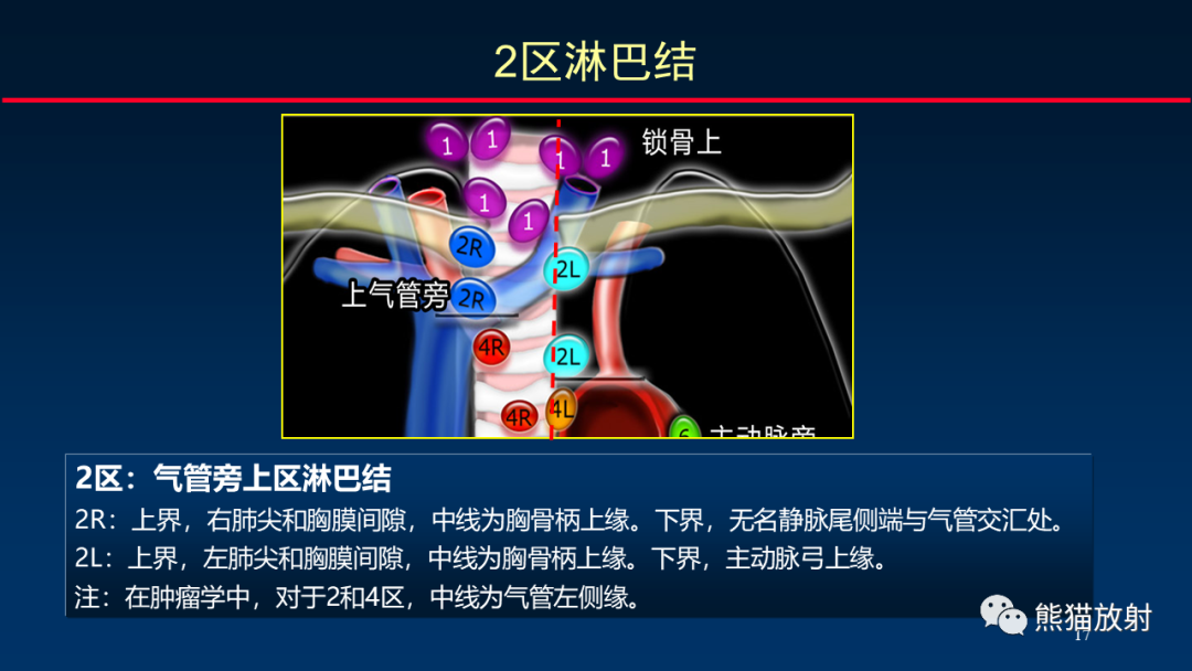 影像PPT - 【PPT】纵隔与肺门淋巴结的识别与精准CT分区-17