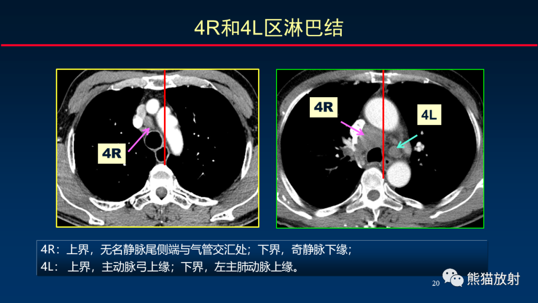 影像PPT - 【PPT】纵隔与肺门淋巴结的识别与精准CT分区-20
