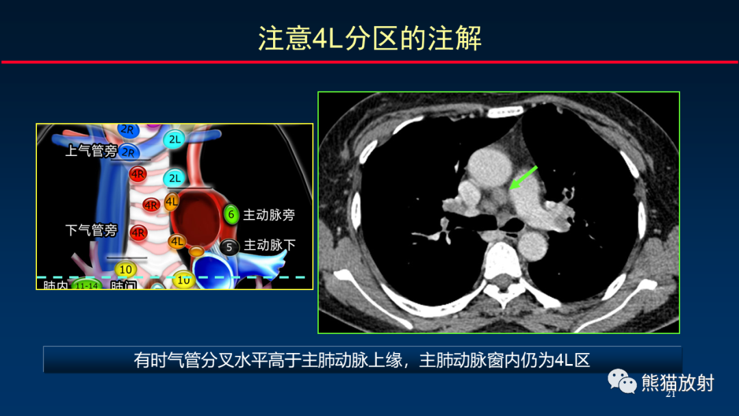 影像PPT - 【PPT】纵隔与肺门淋巴结的识别与精准CT分区-21