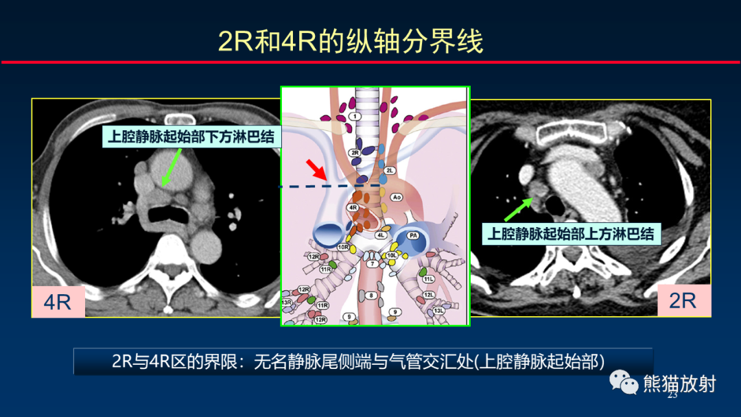 影像PPT - 【PPT】纵隔与肺门淋巴结的识别与精准CT分区-23