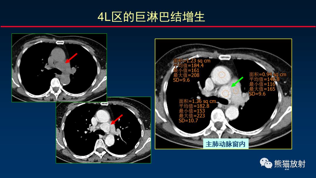 影像PPT - 【PPT】纵隔与肺门淋巴结的识别与精准CT分区-22