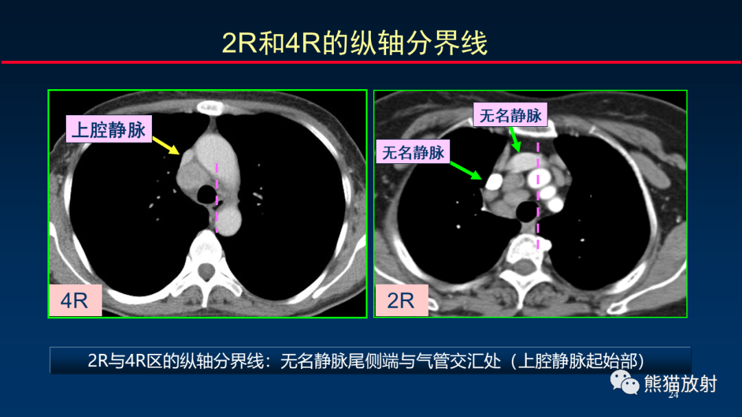 影像PPT - 【PPT】纵隔与肺门淋巴结的识别与精准CT分区-24