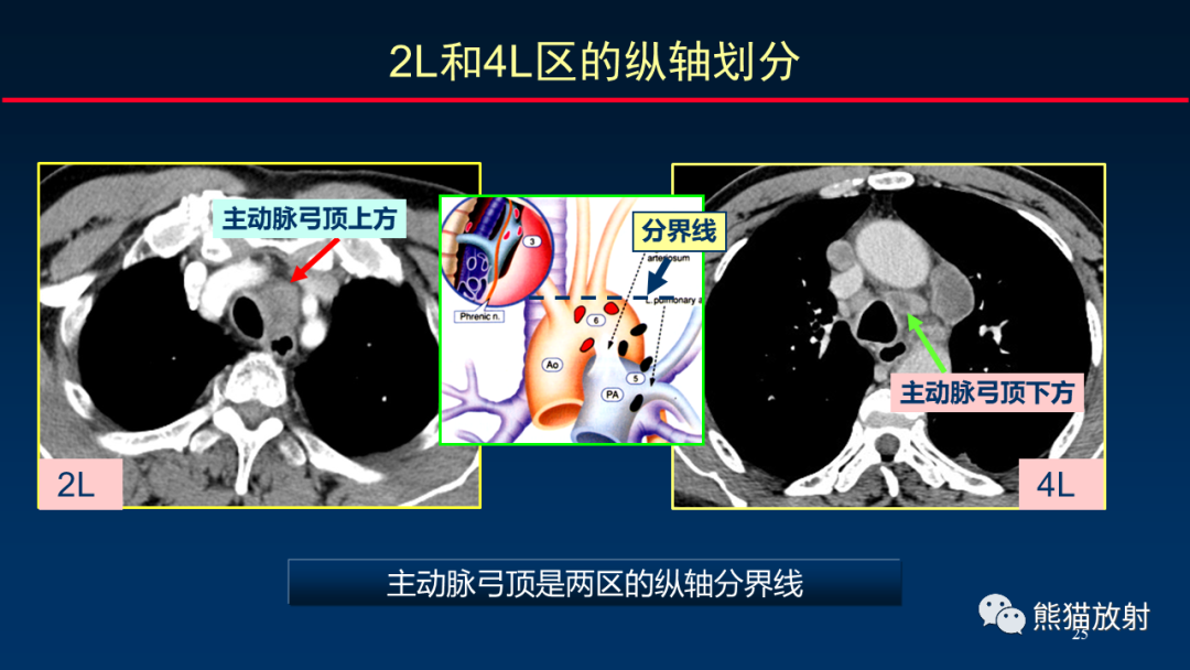 影像PPT - 【PPT】纵隔与肺门淋巴结的识别与精准CT分区-25