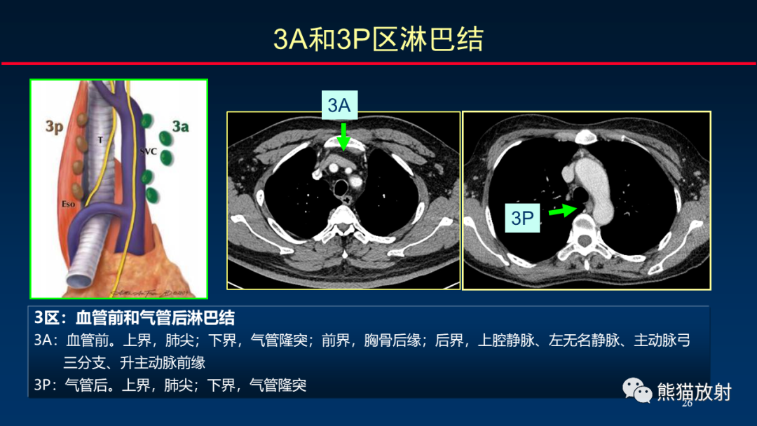 影像PPT - 【PPT】纵隔与肺门淋巴结的识别与精准CT分区-26