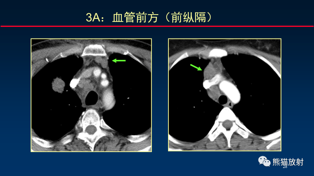 影像PPT - 【PPT】纵隔与肺门淋巴结的识别与精准CT分区-28