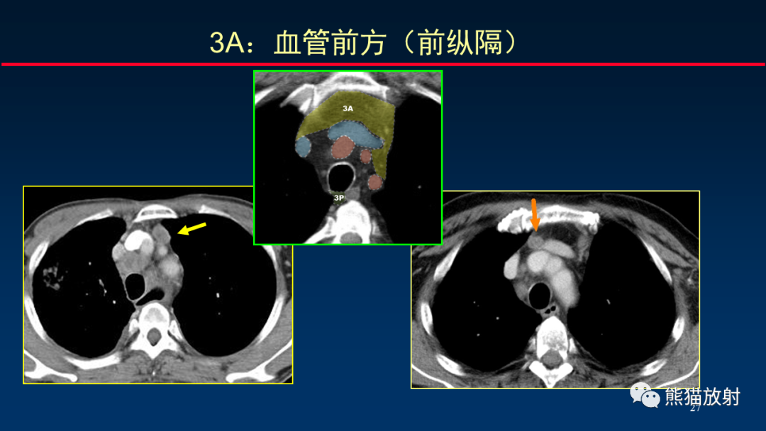 影像PPT - 【PPT】纵隔与肺门淋巴结的识别与精准CT分区-27