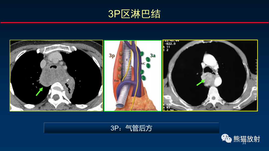 影像PPT - 【PPT】纵隔与肺门淋巴结的识别与精准CT分区-31