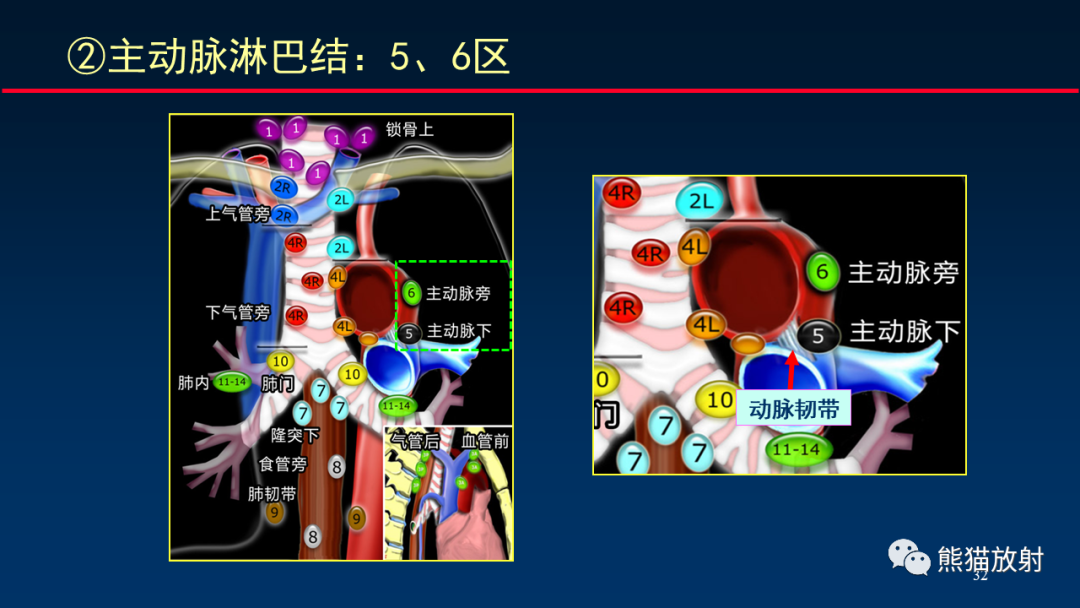 影像PPT - 【PPT】纵隔与肺门淋巴结的识别与精准CT分区-32