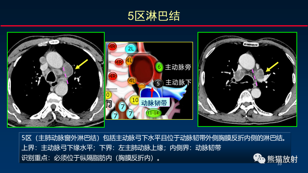 影像PPT - 【PPT】纵隔与肺门淋巴结的识别与精准CT分区-33