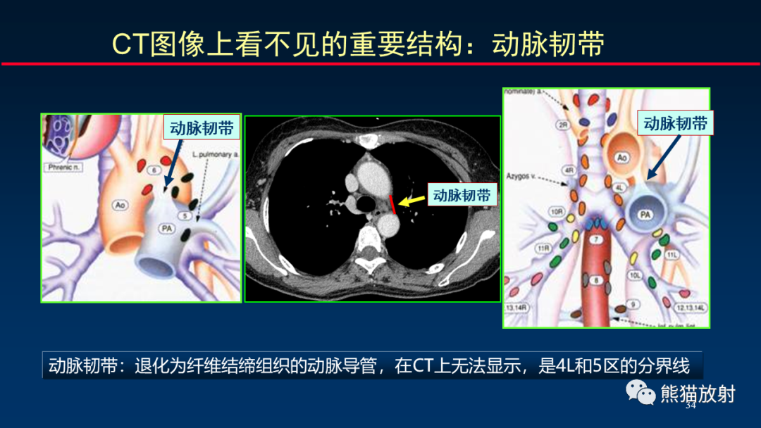 影像PPT - 【PPT】纵隔与肺门淋巴结的识别与精准CT分区-34