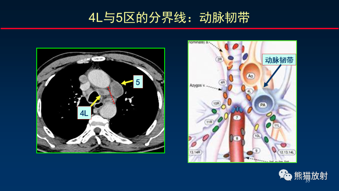 影像PPT - 【PPT】纵隔与肺门淋巴结的识别与精准CT分区-35