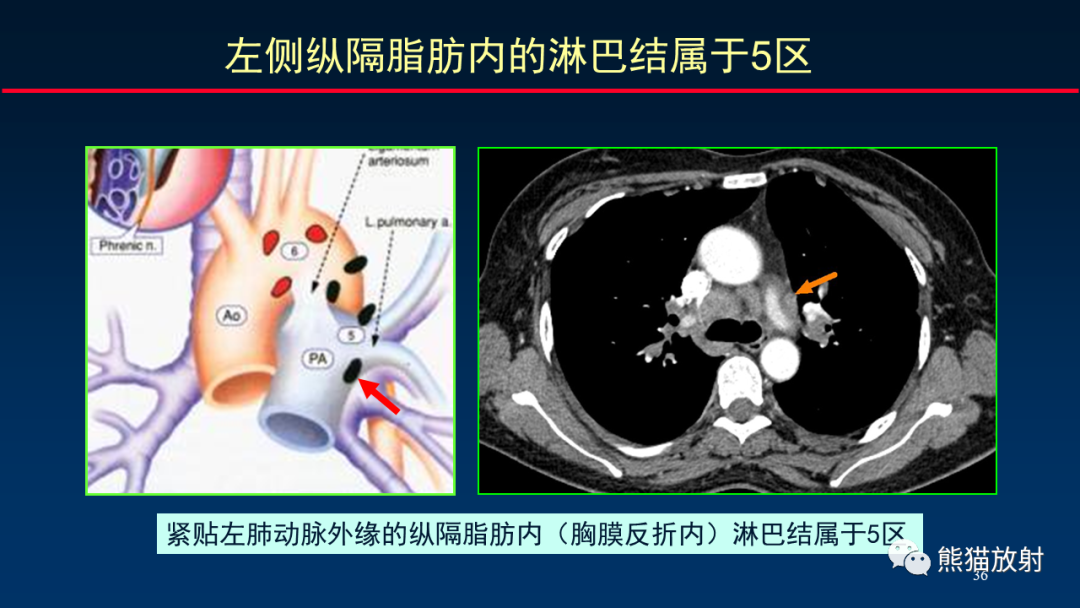 影像PPT - 【PPT】纵隔与肺门淋巴结的识别与精准CT分区-36