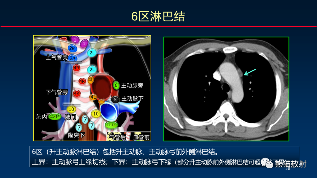 影像PPT - 【PPT】纵隔与肺门淋巴结的识别与精准CT分区-38