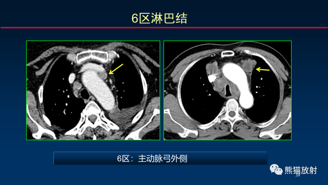 影像PPT - 【PPT】纵隔与肺门淋巴结的识别与精准CT分区-39