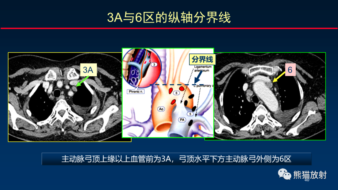 影像PPT - 【PPT】纵隔与肺门淋巴结的识别与精准CT分区-40