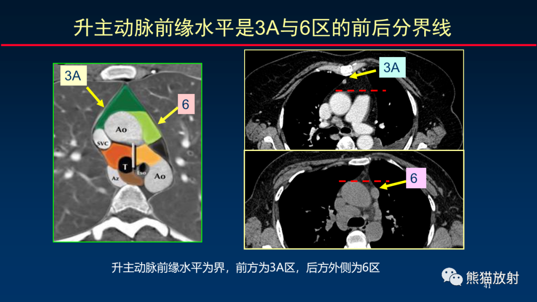 影像PPT - 【PPT】纵隔与肺门淋巴结的识别与精准CT分区-41