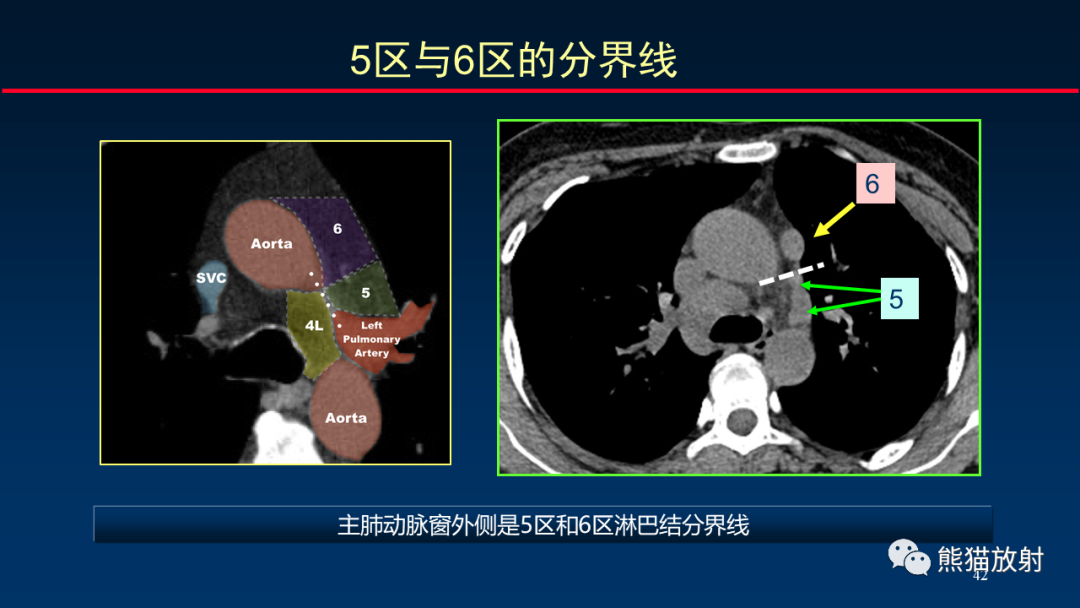 影像PPT - 【PPT】纵隔与肺门淋巴结的识别与精准CT分区-42