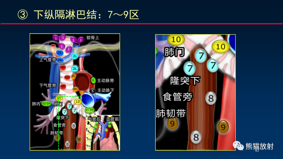 影像PPT - 【PPT】纵隔与肺门淋巴结的识别与精准CT分区-43
