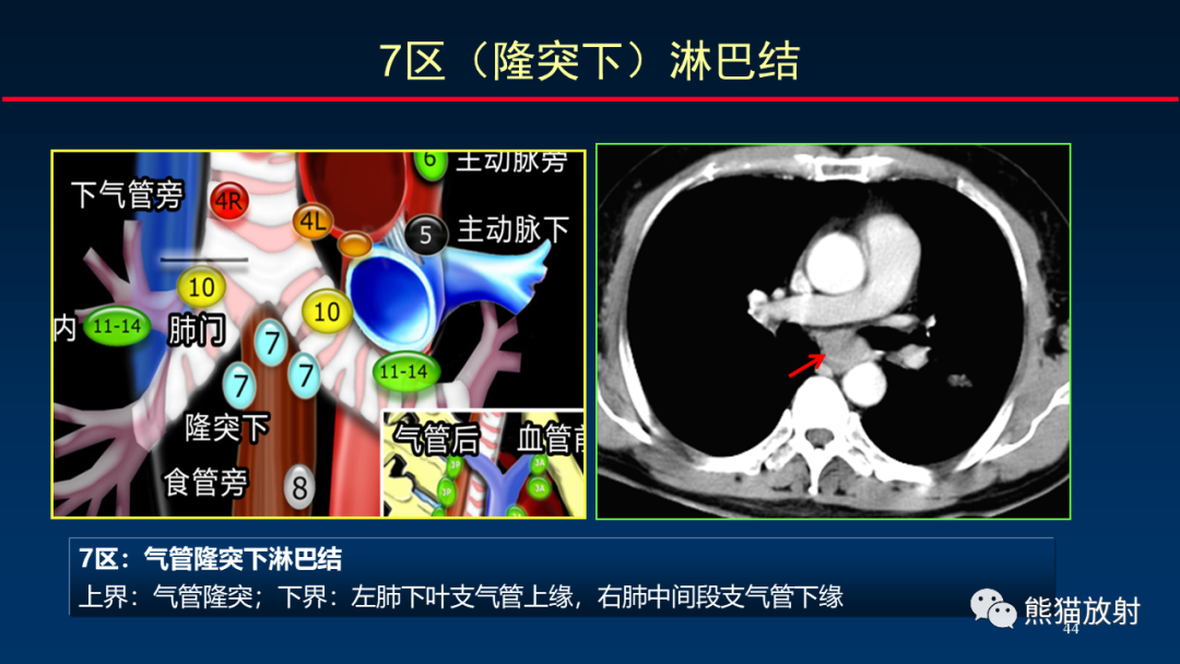 影像PPT - 【PPT】纵隔与肺门淋巴结的识别与精准CT分区-44
