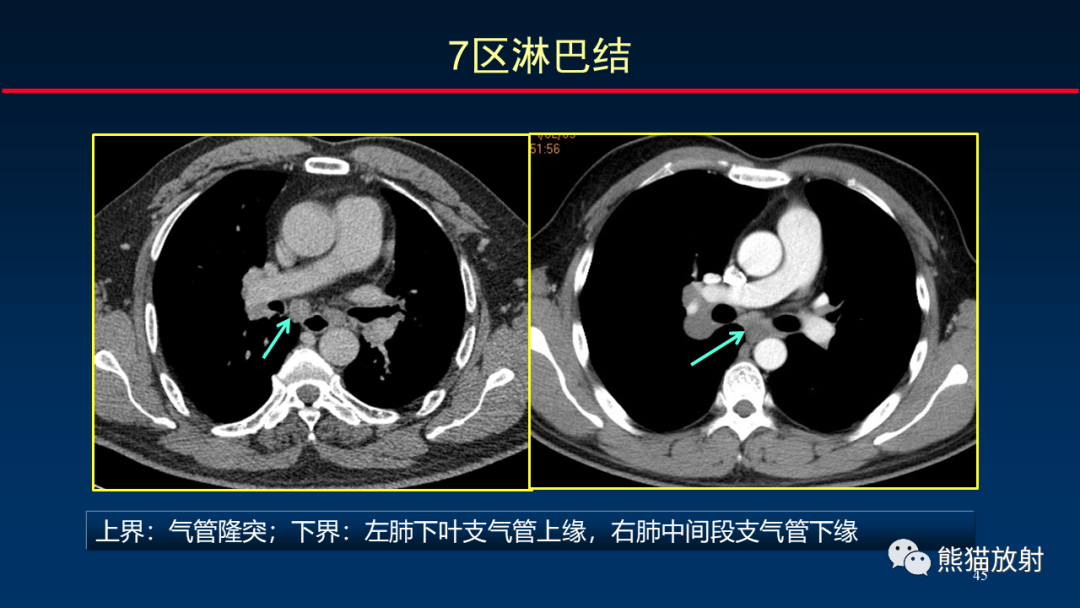 影像PPT - 【PPT】纵隔与肺门淋巴结的识别与精准CT分区-45