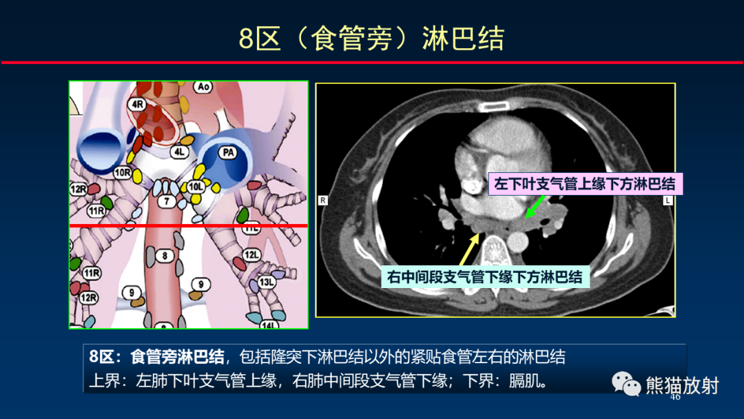 影像PPT - 【PPT】纵隔与肺门淋巴结的识别与精准CT分区-46