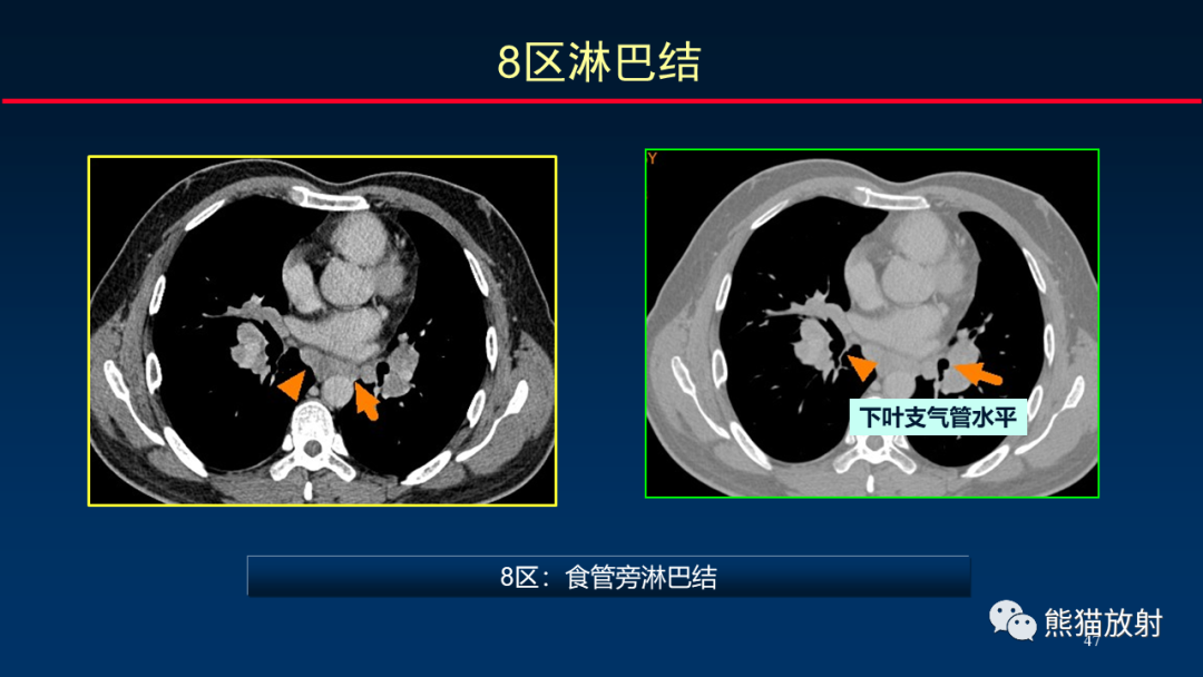 影像PPT - 【PPT】纵隔与肺门淋巴结的识别与精准CT分区-47