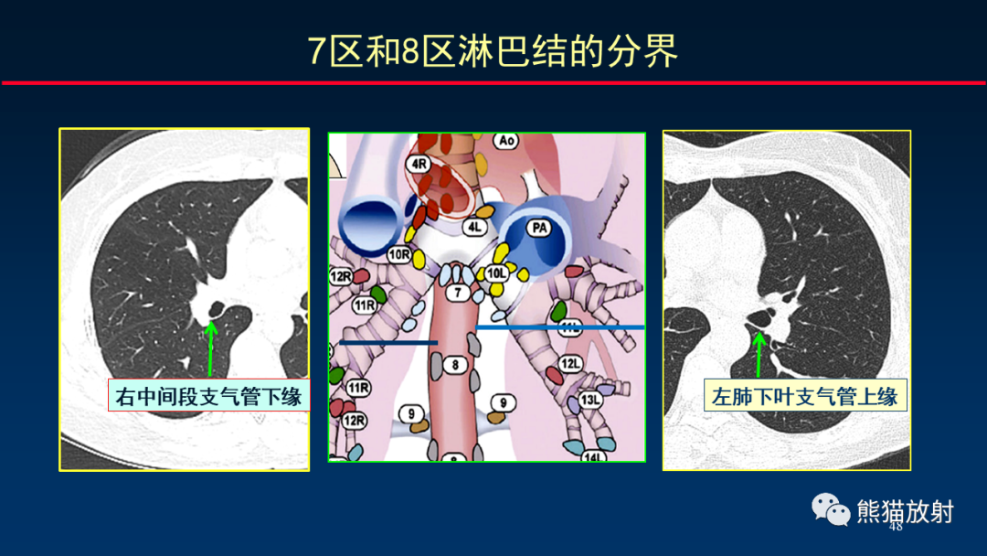 影像PPT - 【PPT】纵隔与肺门淋巴结的识别与精准CT分区-48