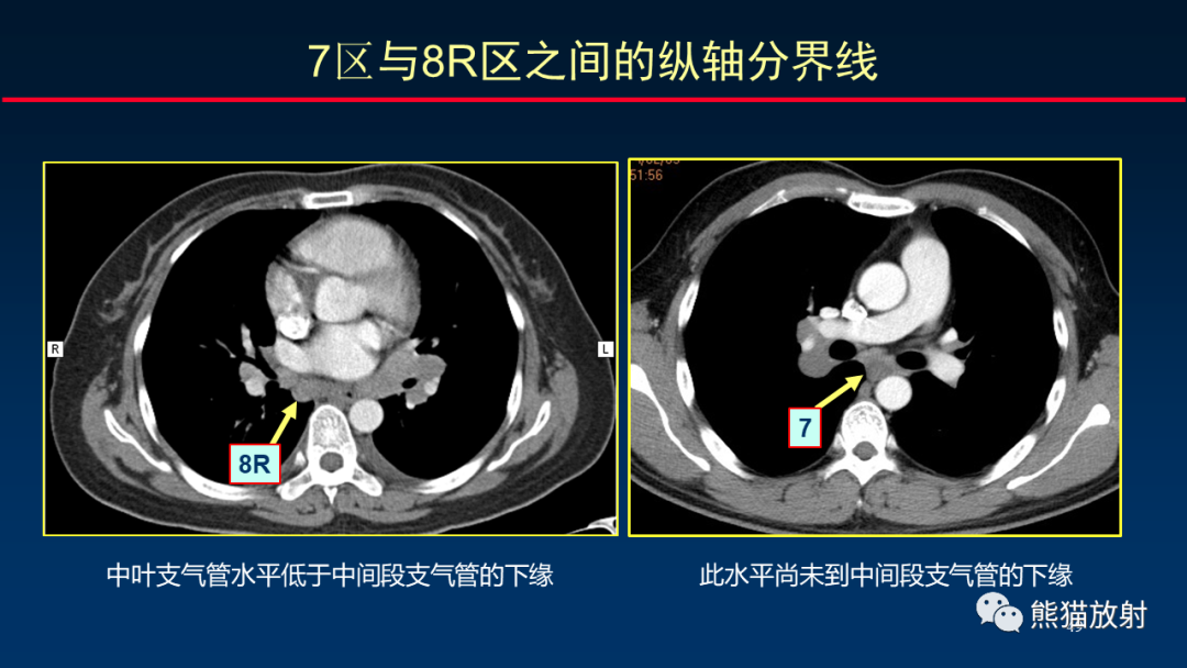 影像PPT - 【PPT】纵隔与肺门淋巴结的识别与精准CT分区-49