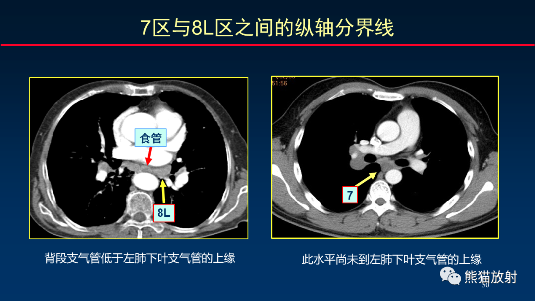 影像PPT - 【PPT】纵隔与肺门淋巴结的识别与精准CT分区-50