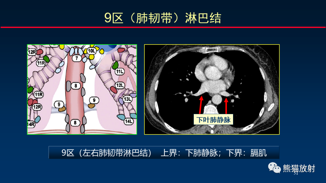 影像PPT - 【PPT】纵隔与肺门淋巴结的识别与精准CT分区-51