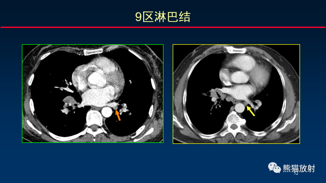 影像PPT - 【PPT】纵隔与肺门淋巴结的识别与精准CT分区-52
