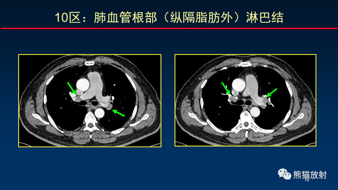 影像PPT - 【PPT】纵隔与肺门淋巴结的识别与精准CT分区-56