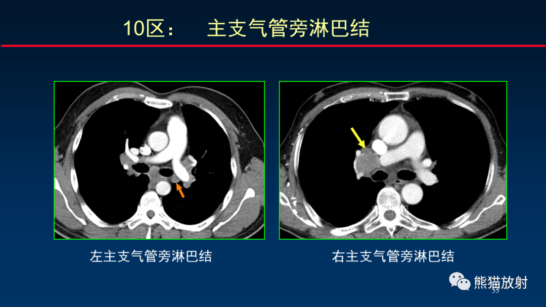 影像PPT - 【PPT】纵隔与肺门淋巴结的识别与精准CT分区-55