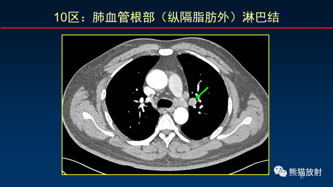影像PPT - 【PPT】纵隔与肺门淋巴结的识别与精准CT分区-57