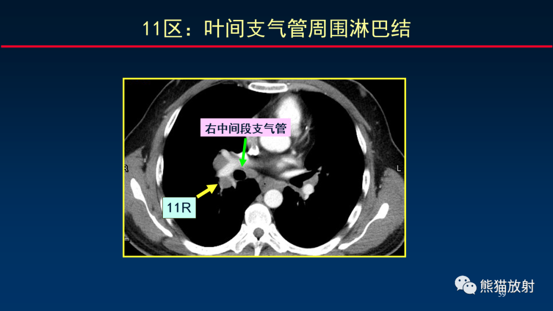 影像PPT - 【PPT】纵隔与肺门淋巴结的识别与精准CT分区-59