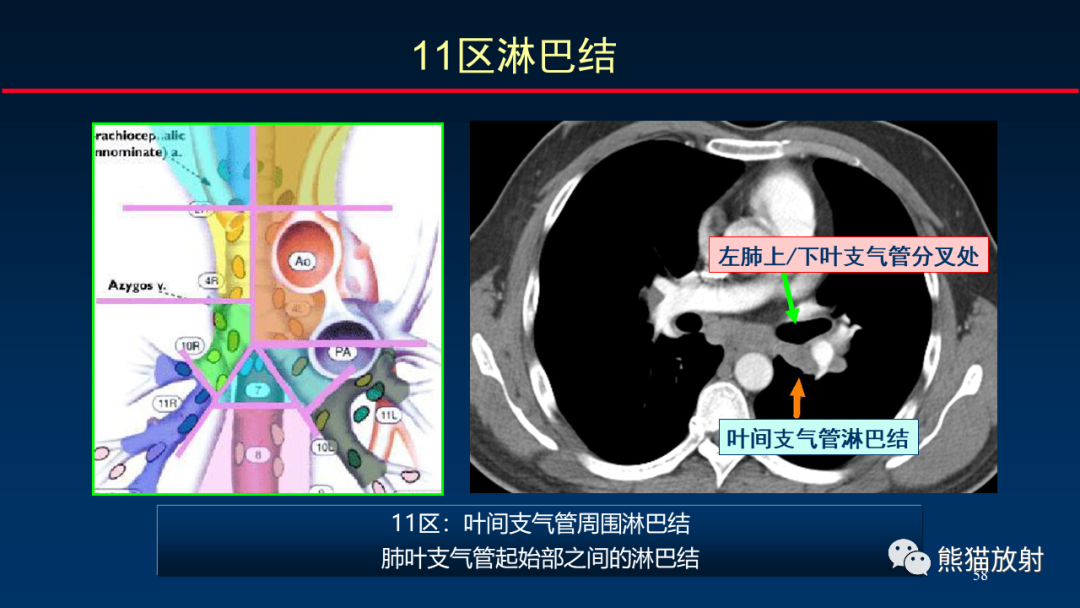 影像PPT - 【PPT】纵隔与肺门淋巴结的识别与精准CT分区-58