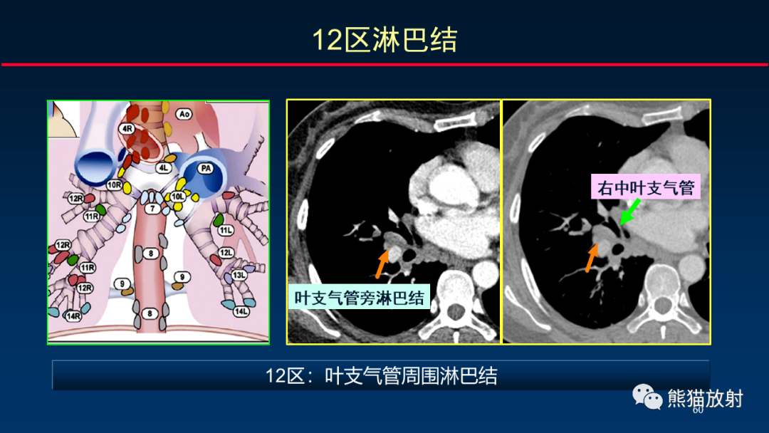影像PPT - 【PPT】纵隔与肺门淋巴结的识别与精准CT分区-60